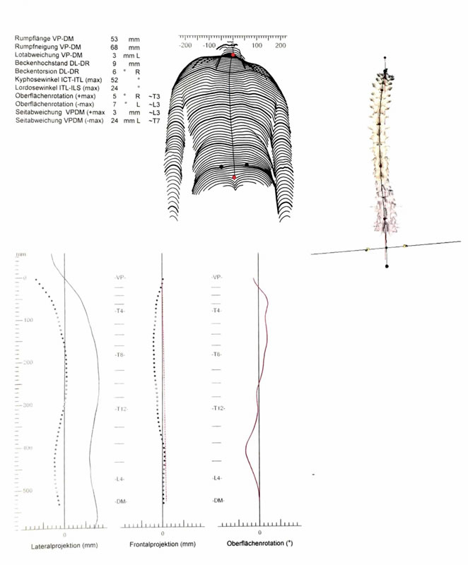 Formetric 3D- Oberflächenscan/Wirbelsäulenscan - Daniel Bremer - Master of Science Chiropraktik, Heilpraktiker, Physiotherapeut, Osteopath - Dortmund